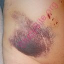 bruise (Oops! image not found)